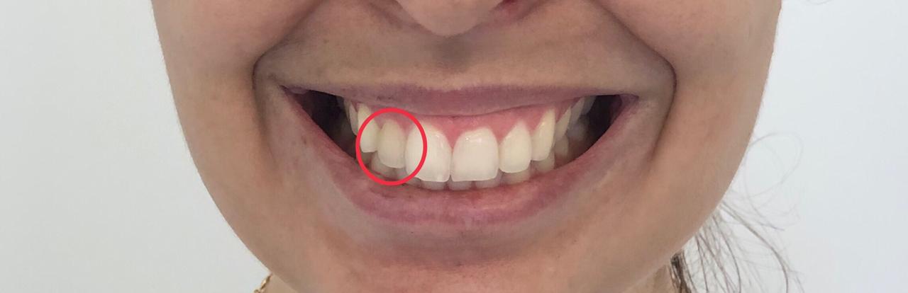 Como funciona o alinhador dental transparente? Ele é melhor que o de metal?  - 27/06/2019 - UOL VivaBem